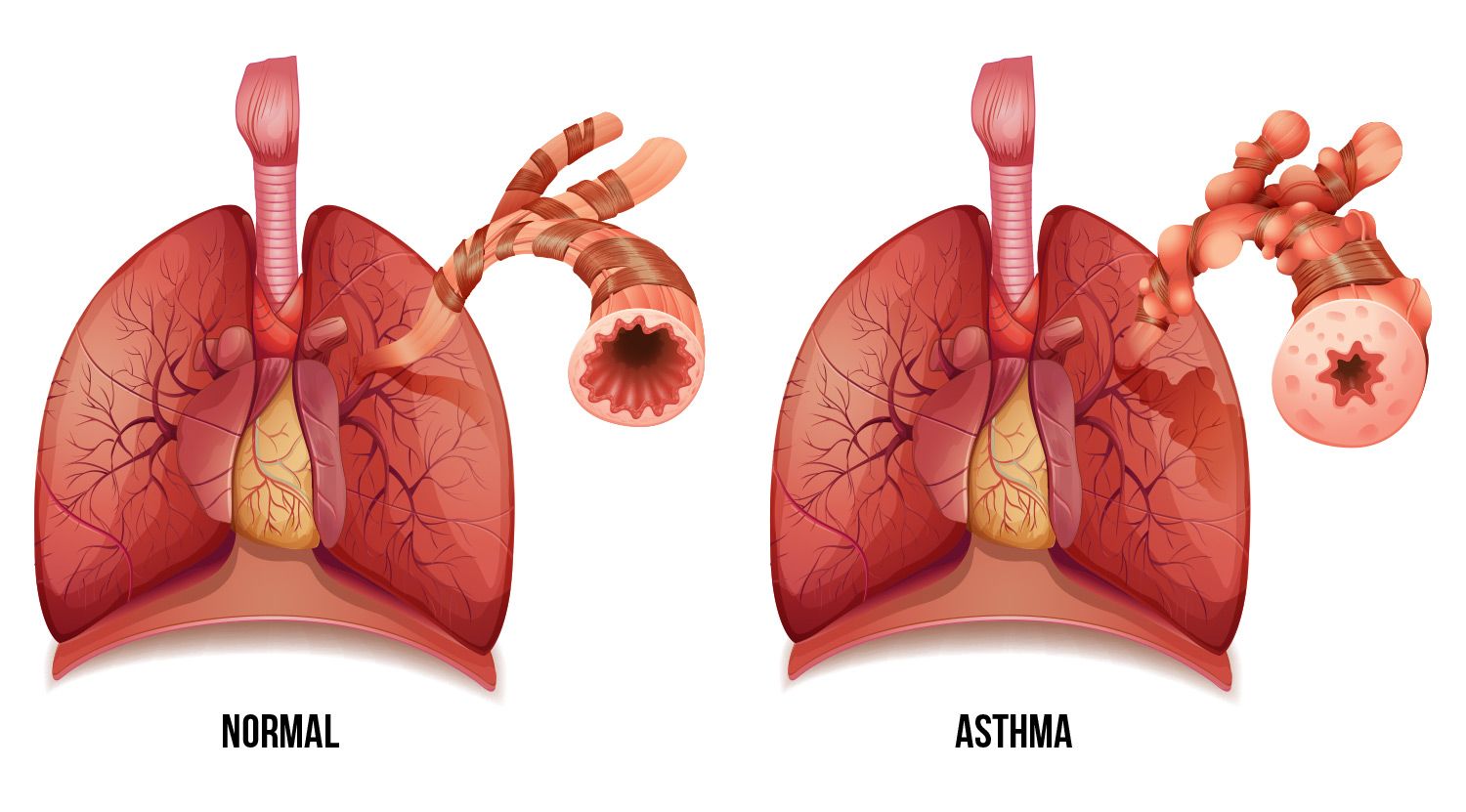 Astma